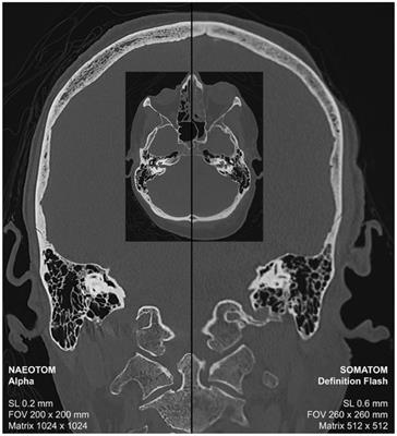 Photon-counting CT for forensic death investigations—a glance into the future of virtual autopsy